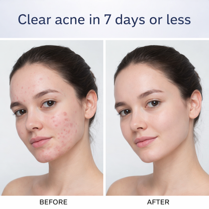 Revérau Acne Slaying Lotion